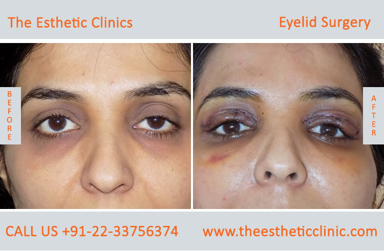 Eyelid Surgery, Blepharoplasty before after photos in mumbai india (9)